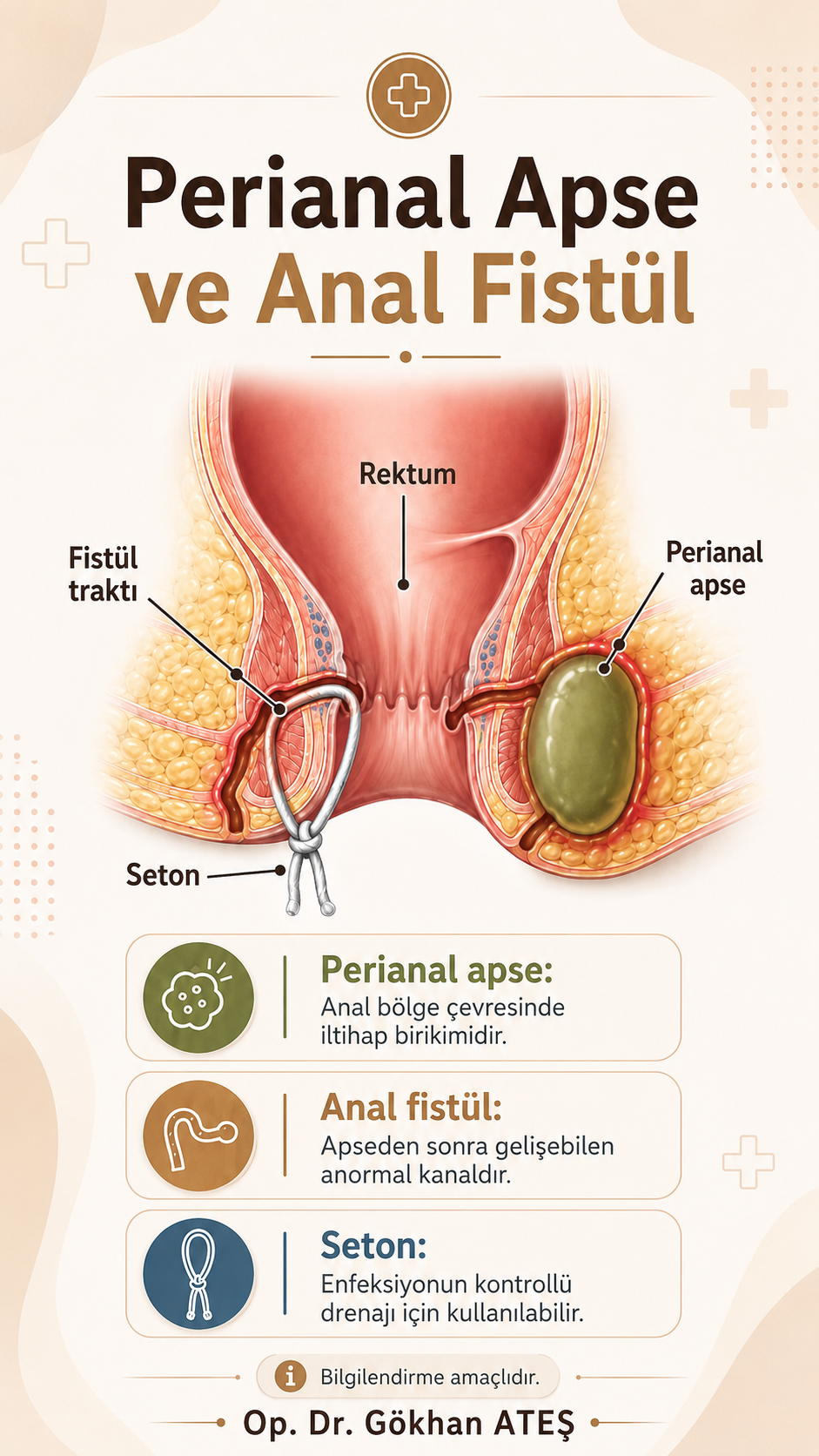 Perianal apse, anal fistül ve seton uygulaması anatomik infografik gösterimi